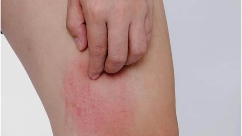 Hai bộ phận trên cơ thể ngứa ngáy là dấu hiệu của bệnh UT gan, nhiều người lại lầm tưởng là dị ứng