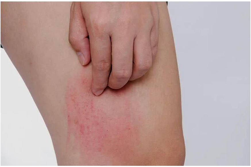 Hai bộ phận trên cơ thể ngứa ngáy là dấu hiệu của bệnh UT gan, nhiều người lại lầm tưởng là dị ứng